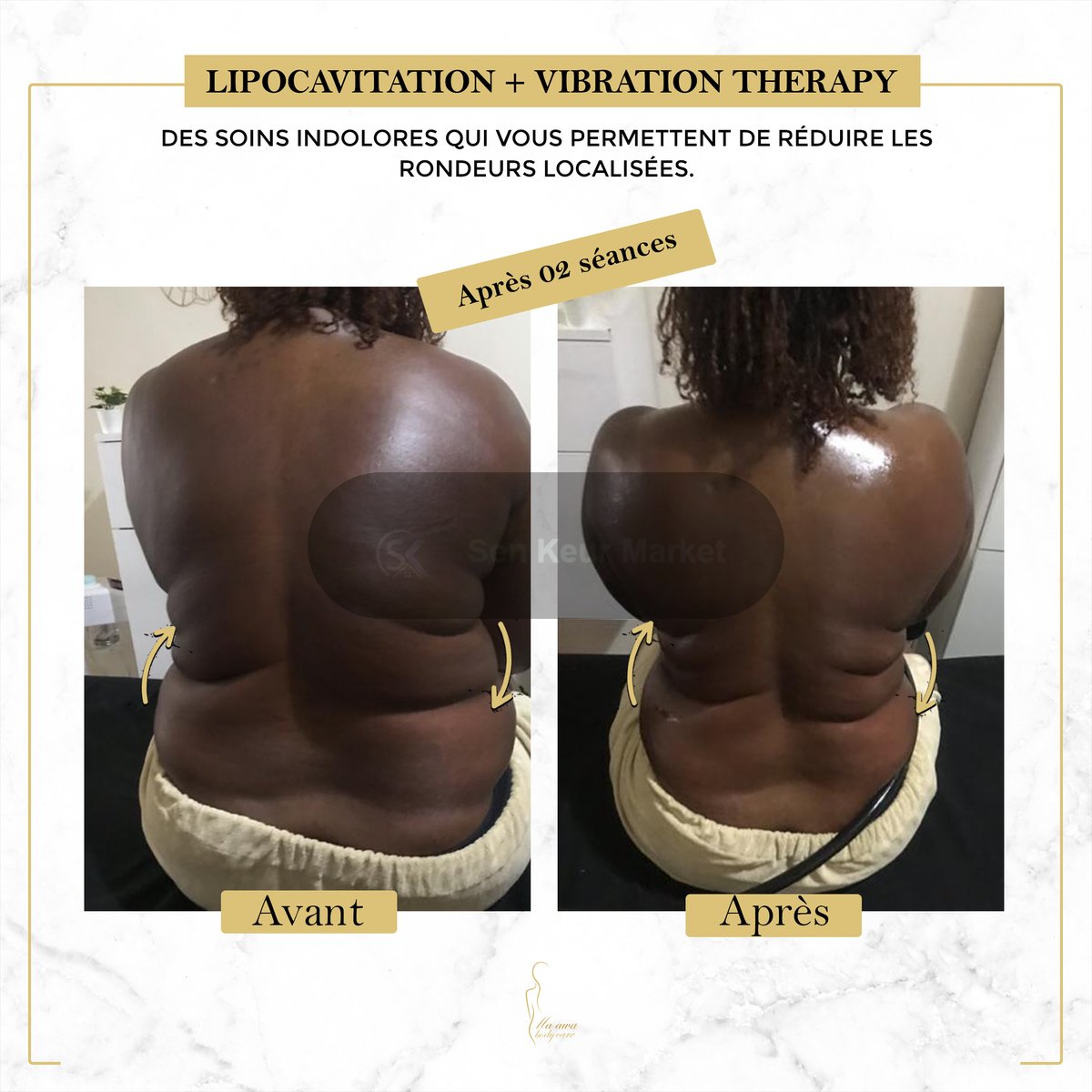 Affinez Votre Silhouette Sans Chirurgie