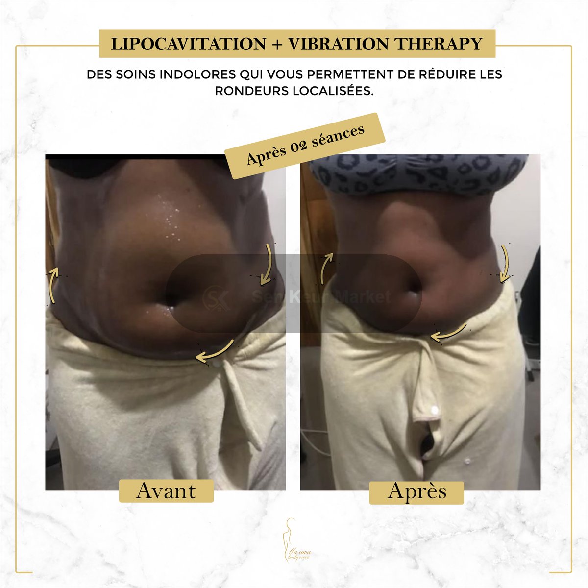 Affinez Votre Silhouette Sans Chirurgie — photo 2