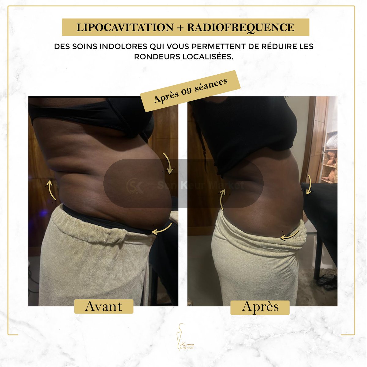 Affinez Votre Silhouette Sans Chirurgie — photo 7