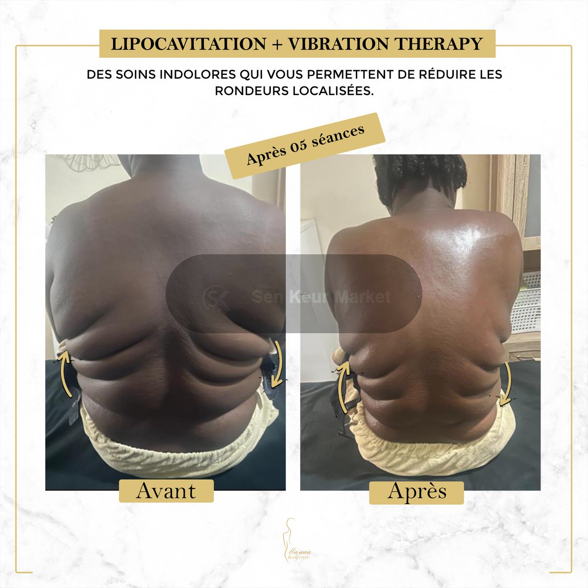 Affinez Votre Silhouette Sans Chirurgie — photo 4