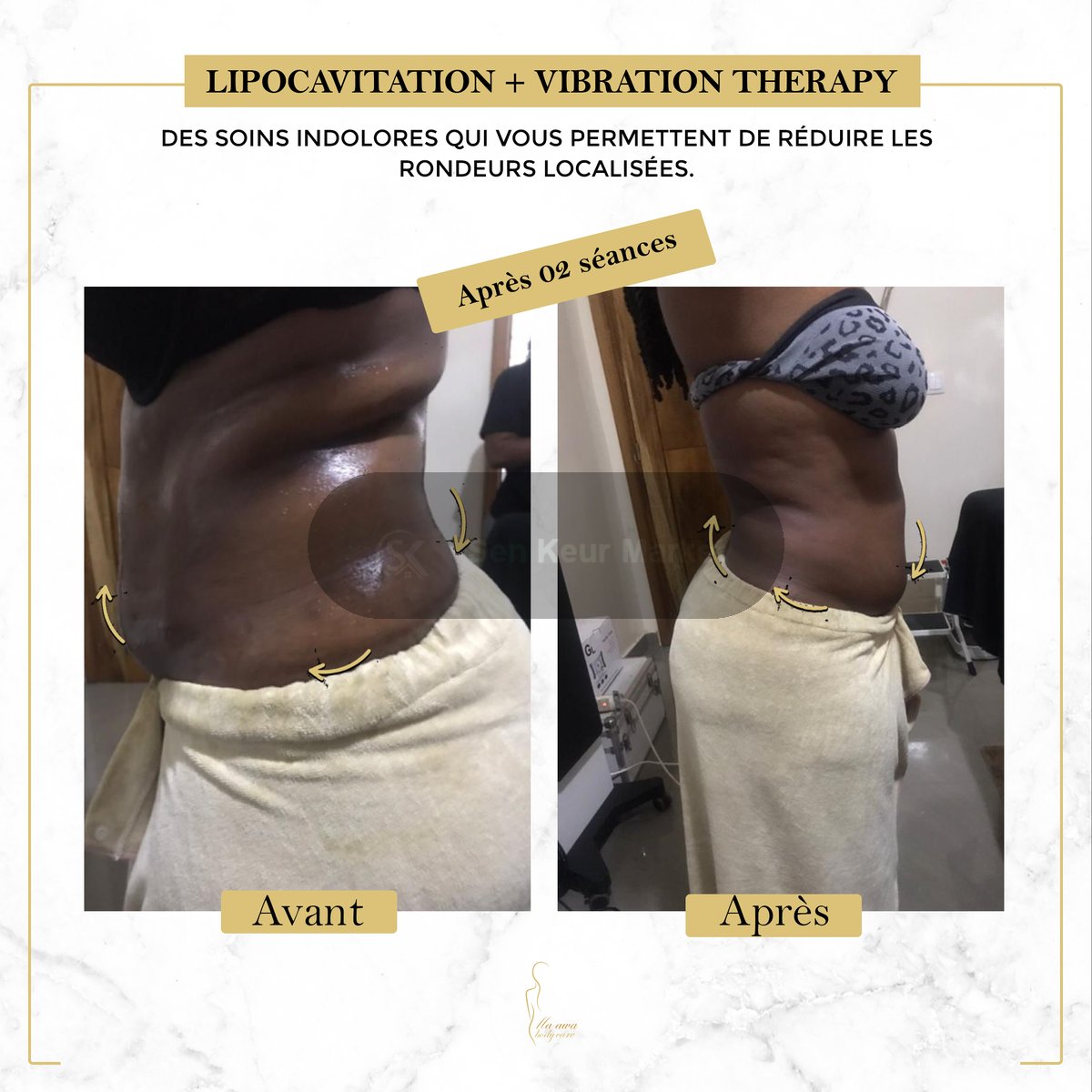Affinez Votre Silhouette Sans Chirurgie — photo 5