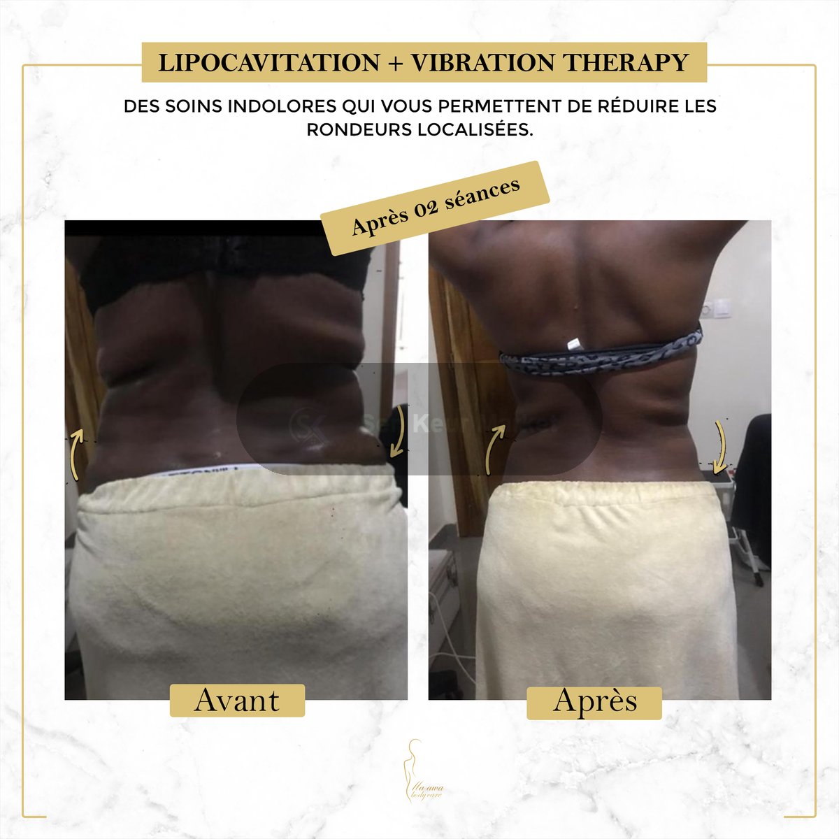 Affinez Votre Silhouette Sans Chirurgie — photo 6