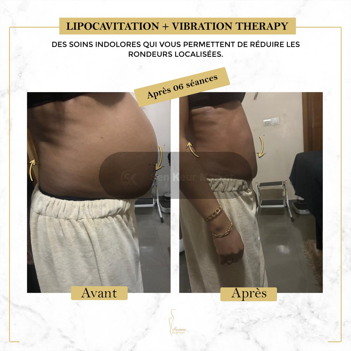 Affinez Votre Silhouette Sans Chirurgie — photo 3